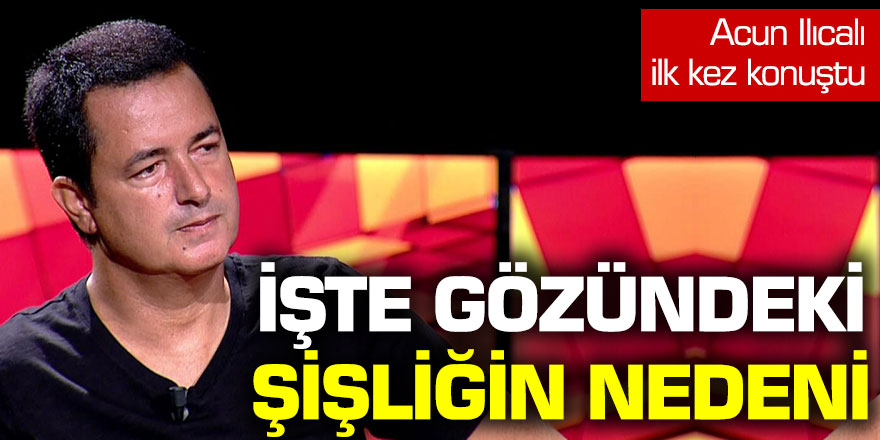 Acun Ilıcalı ilk kez açıkladı: İşte gözündeki şişliğin nedeni