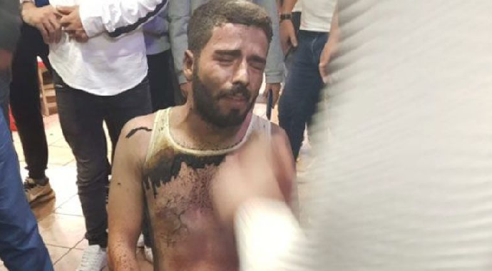 Eşine Kızıp Kendini Ateşe Verdi